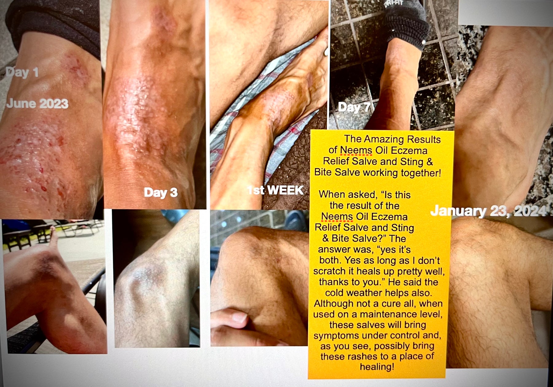 Amazing Eczema Healing Results with Neems Oil Eczema Relief Salve and Sting & Bite Salve